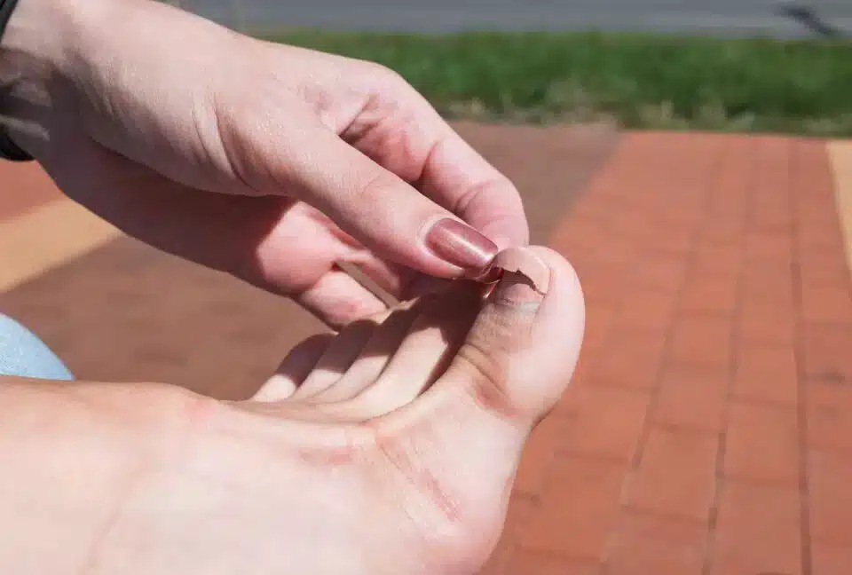 a broken toe nail